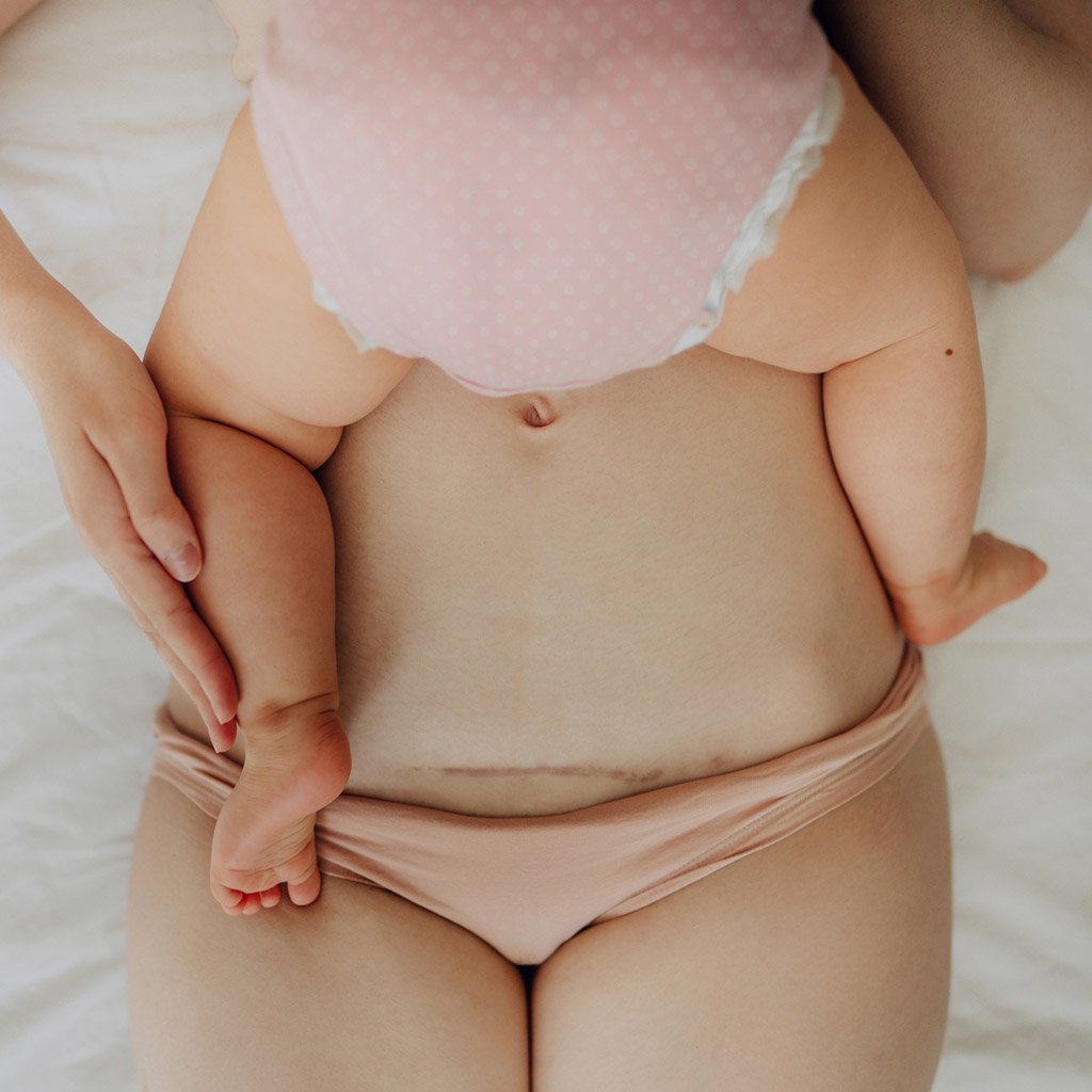 Шов после кесарева сечения: как ухаживать » EVA Blog